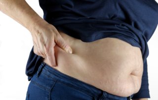 Fettabsaugung hilft bei Übergewicht