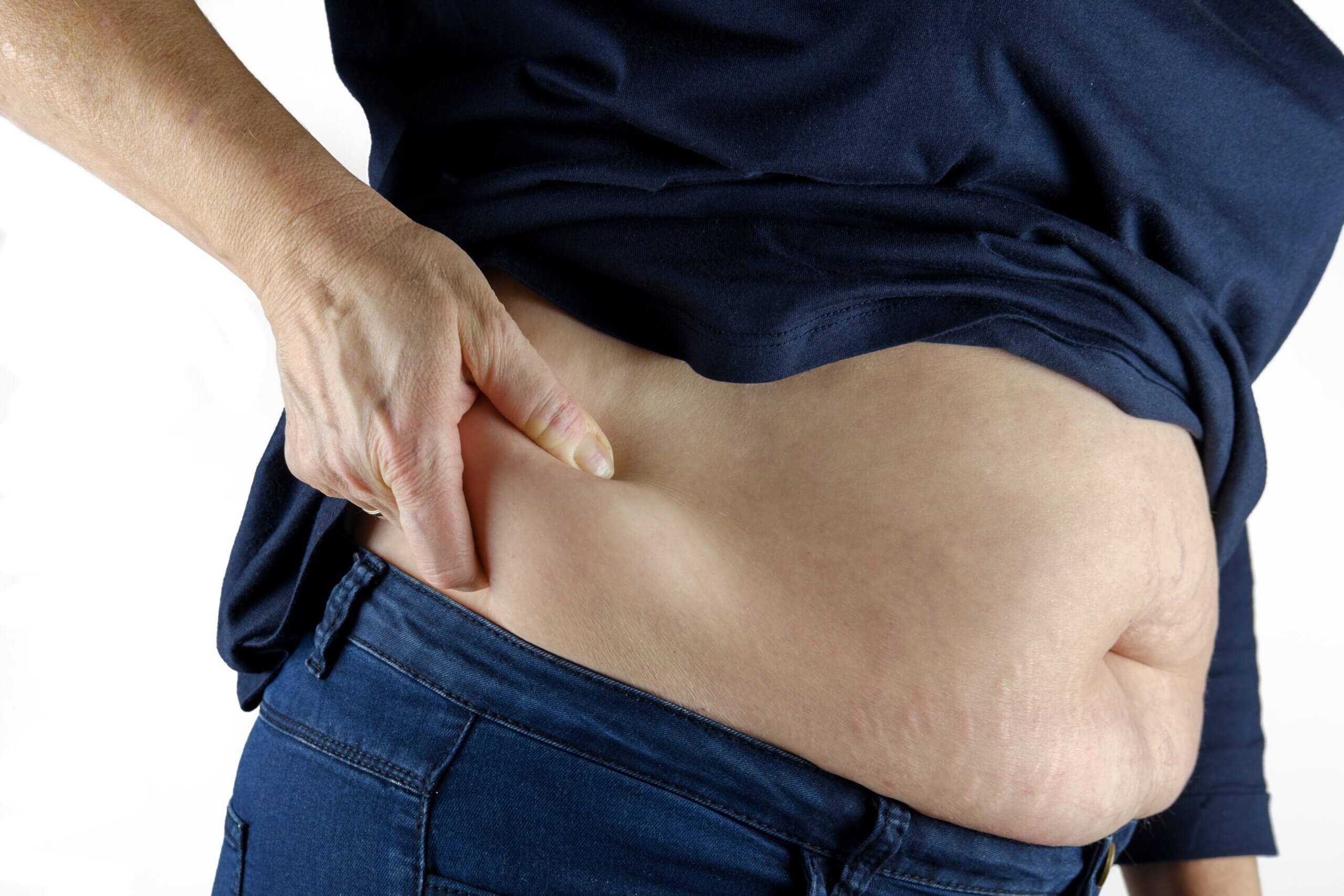 Fettabsaugung hilft bei Übergewicht
